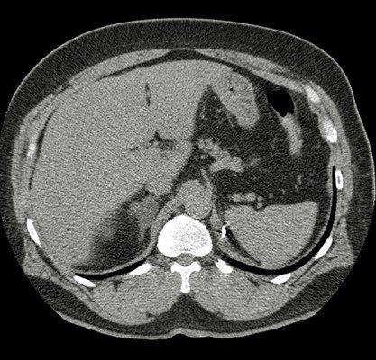 Healthool Adrenal adenoma - Symptoms, Causes, Diagnosis