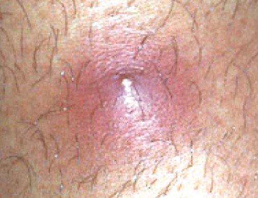 Ingrown hair - Pictures, Treatment, Removal and Causes ...