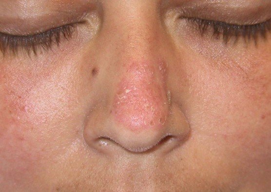 Discoid Lupus Pictures Symptoms Treatment Causes 2018 Updated