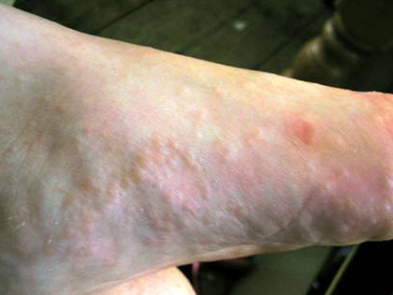 dyshidrotic eczema pictures 2