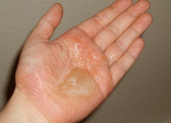 dyshidrotic eczema pictures 4