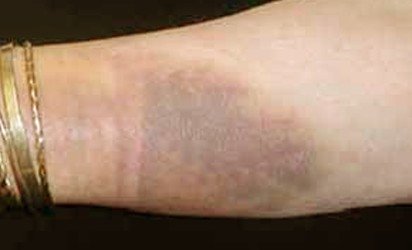 Ecchymosis Medical Definition