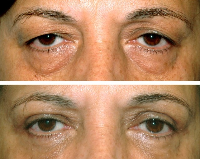eyelid surgery before and after photos 2