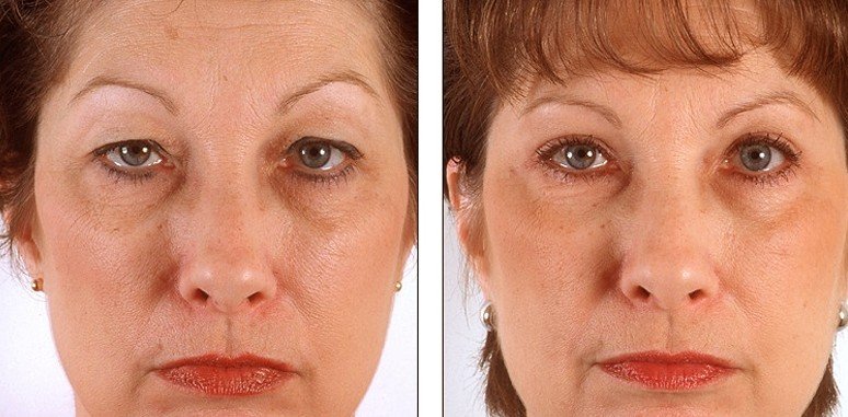 eyelid-surgery-photos-recovery-time-procedure-cost-december-2021