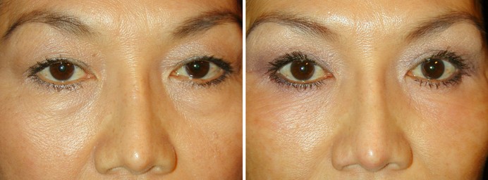 eyelid surgery before and after photos