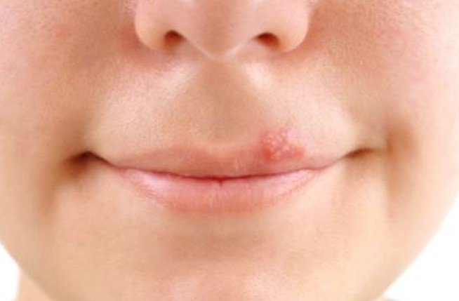 5-home-remedies-for-blisters-on-tongue-by-top-5-youtube