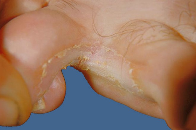 foot fungus pictures 3
