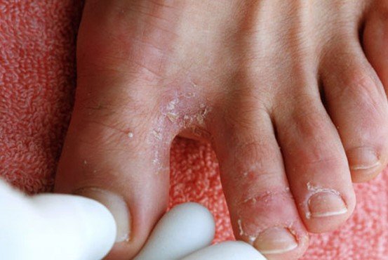 Foot Fungus - Pictures, Types, Causes, Symptoms, Treatment - (2018