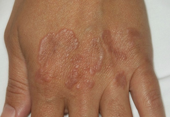 granuloma annulare pictures 2