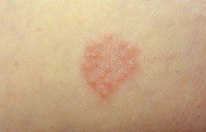 Healthoolgranuloma annulare pictures | Healthool