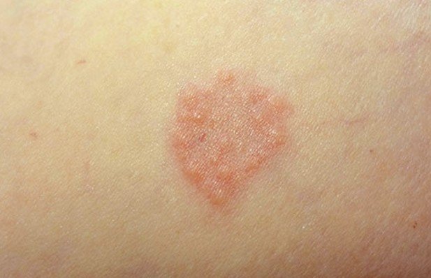 👉 Granuloma Annulare Pictures Causes Contagious Symptoms