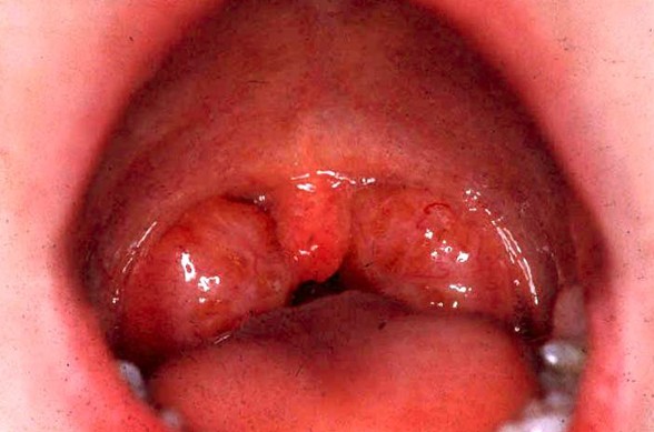👉 Inflamed Tonsils Pictures Causes Symptoms Treatment November 2021