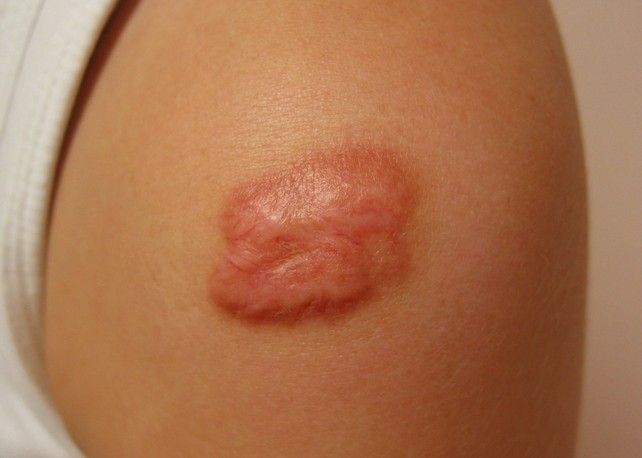 keloid pictures 4
