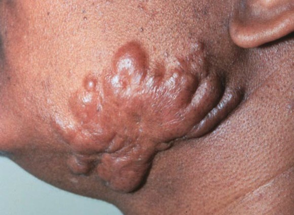 keloid pictures