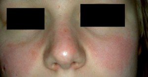 Lupus Rash - Pictures, Symptoms, Causes, Treatment - (2020 - Updated)
