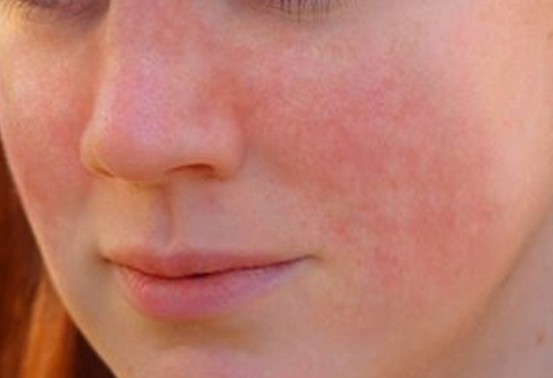 lupus rash pictures 3