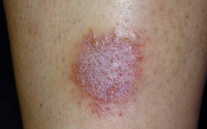 nummular eczema pictures 5