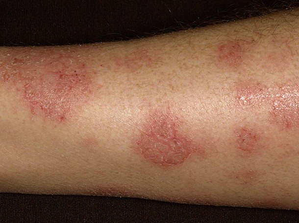 Nummular Eczema - Pictures, Treatment, Causes, Symptoms, Diagnosis