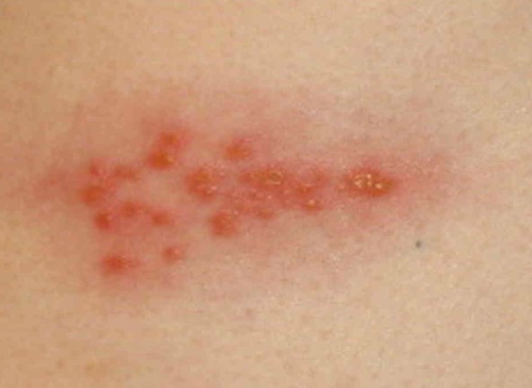 shingles rash pictures
