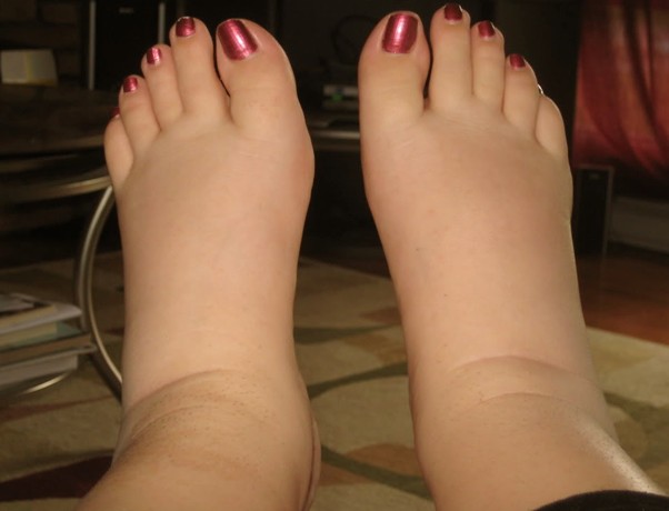 swollen feet pictures 2