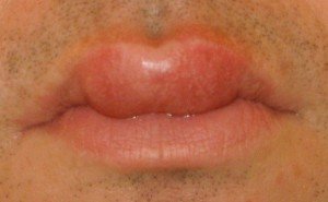 Swollen Lips - Causes, Treatment, Pictures, Remedies