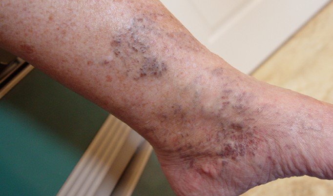 Venous Insufficiency - Pictures, Symptoms, Causes, Treatment - (2021