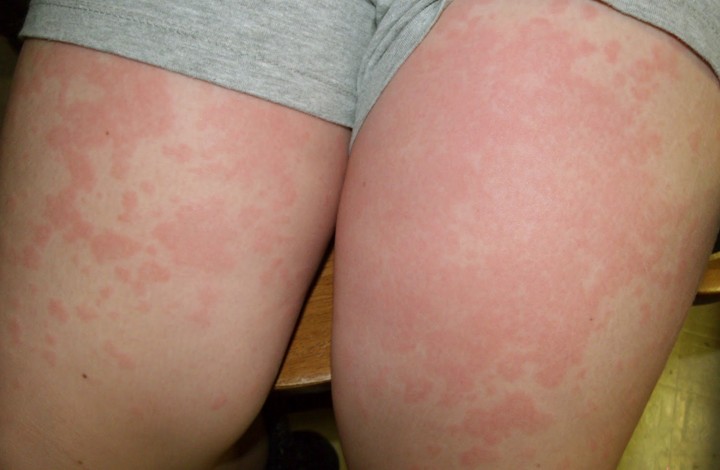 allergic reaction rash 3