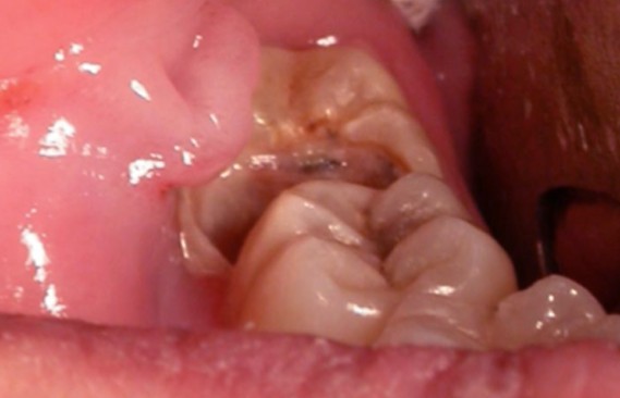 wisdom teeth infection pictures 3