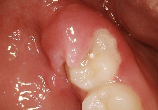 Can Impacted Wisdom Teeth Become Infected