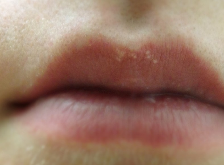 white spots on lips pictures