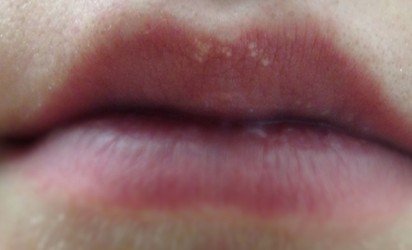 Healthoolwhite Spots On Lips 