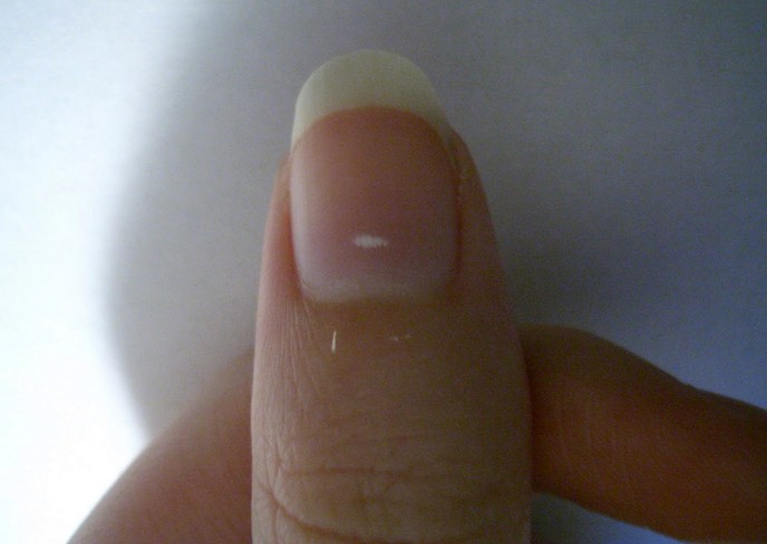 white spots on nails pictures 2