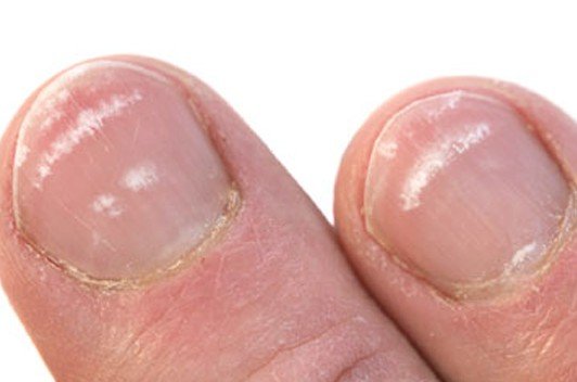 What Do White Spots On Nails Indicate