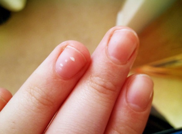 white spots on nails pictures