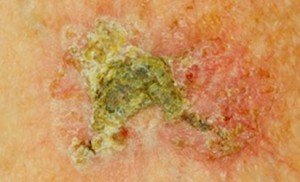 Healthoolactinic keratosis photos | Healthool