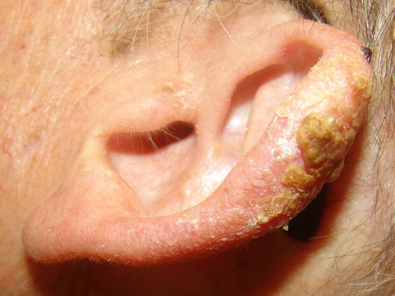 Actinic Keratosis - Pictures, Causes and Treatment - (2018 - Updated)