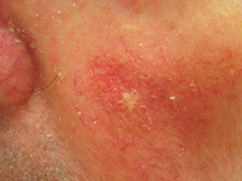 actinic keratosis pictures 5