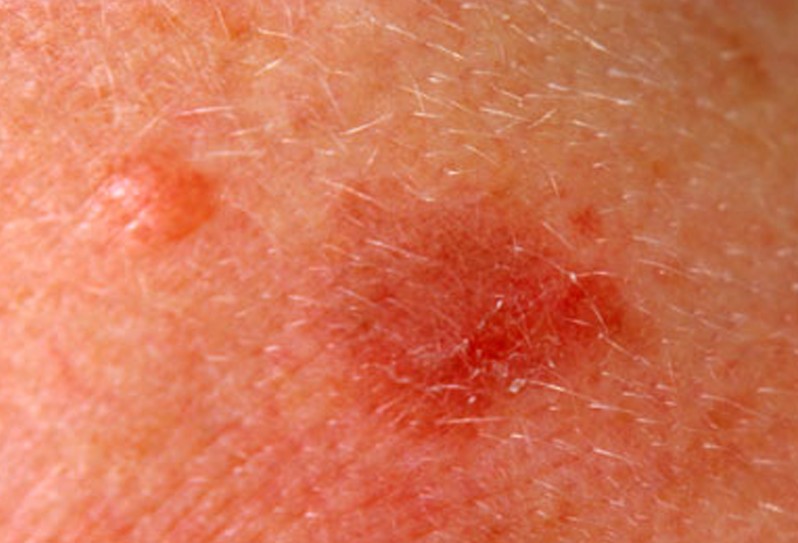actinic keratosis pictures