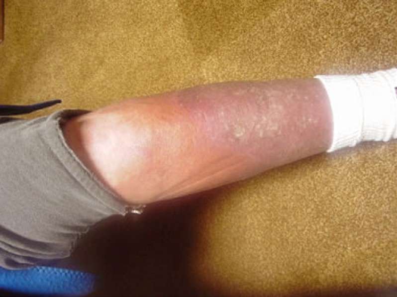 phlebitis pictures