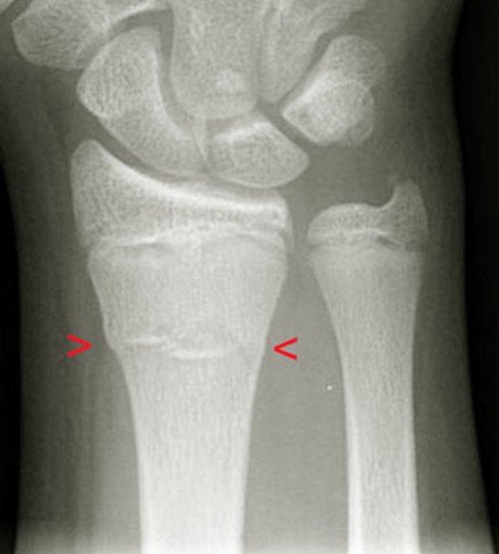 buckle fracture