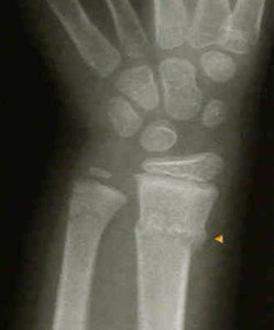 buckle fracture wrist in adults