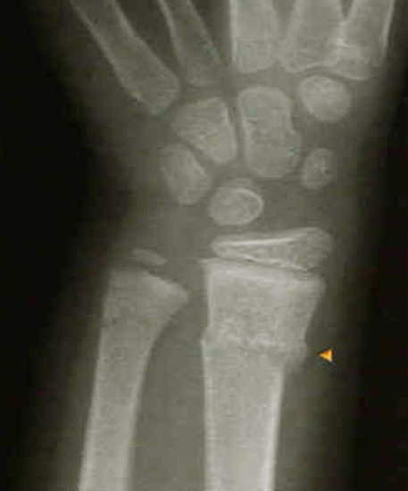 buckle fracture wrist treatment