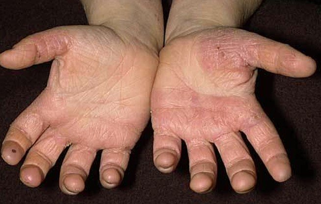 fungal-skin-rash-on-hands