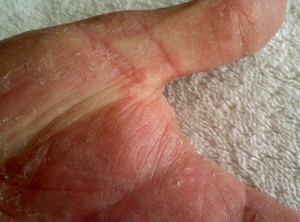 Hand Fungus Picture 1