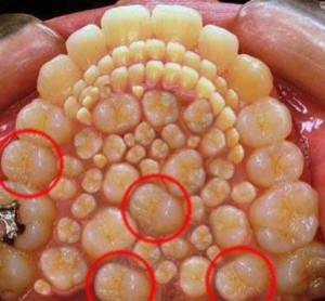 Hyperdontia - Pictures, Causes, Treatment - (2021 - Updated)