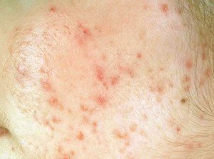 👉 Liver Spots - Pictures (Face, Skin, Hands), Causes, Treatment ...