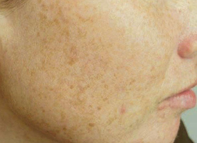 Liver Spots - Pictures (Face, Skin, Hands), Causes 