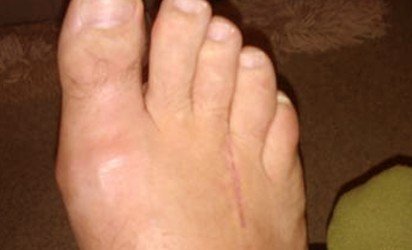 Healthoolmortons neuroma photos | Healthool