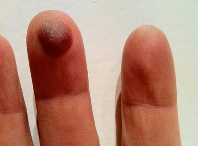 healthoolblood-blister-on-finger-pictures-2-healthool