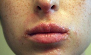 Healthoolbumps on lips photos | Healthool